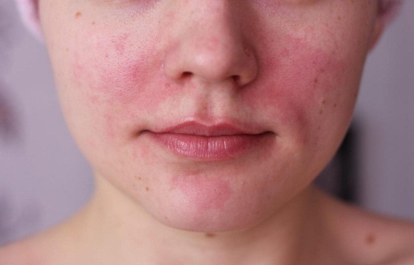 كلوريد الكالسيوم. تعليمات الاستخدام. الخصائص وكيفية تطبيق الحل في تجميل الوجه