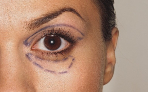 جراحة تجميل الجفن في موسكو. الأسعار في 2020 ، تصنيف العيادات ، كيفية اختيار الجراح ، الترقيات ، الخصومات
