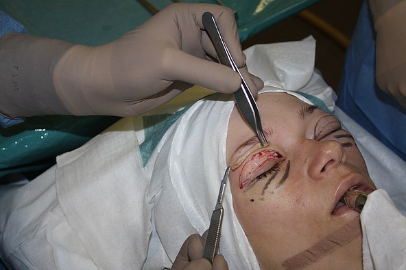 جراحة تجميل الجفن في موسكو. الأسعار في 2020 ، تصنيف العيادات ، كيفية اختيار الجراح ، الترقيات ، الخصومات