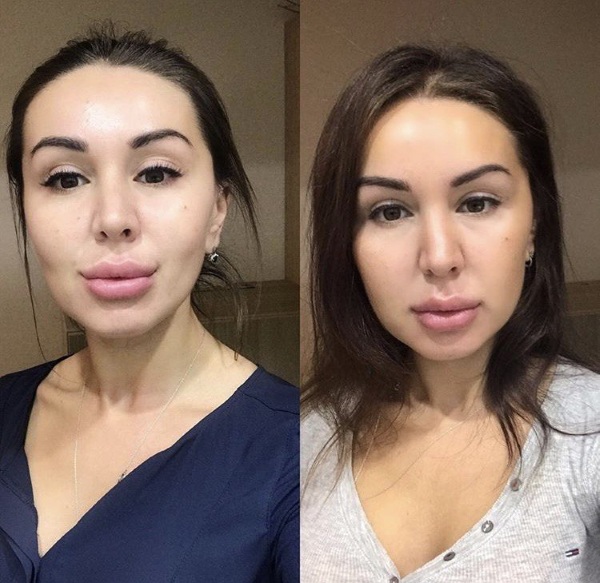 Làm thế nào để loại bỏ các cục của Bisha. Cách vệ sinh tại nhà, xoa bóp, tập thể dục, ăn kiêng, phẫu thuật. Ảnh trước và sau