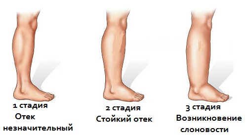 Лимфна дренажна масажа ногу, бутина, стомака са лимфостазом, проширене вене, едеми, проширене вене, трудноћа. Техника како то учинити сами