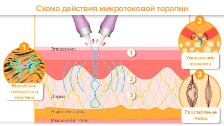 Лимфна дренажна масажа ногу, бутина, стомака са лимфостазом, проширене вене, едеми, проширене вене, трудноћа. Техника како то учинити сами