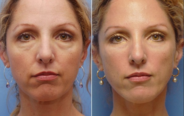 Pengisi restylane, biorevitalisasi. Ulasan. Vital, Perline, Skinbooster untuk pembesaran bibir, di bawah mata. Harga, kecekapan, gambar