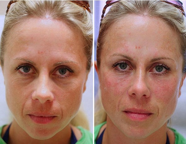 Pengisi restylane, biorevitalisasi. Ulasan. Vital, Perline, Skinbooster untuk pembesaran bibir, di bawah mata. Harga, kecekapan, gambar