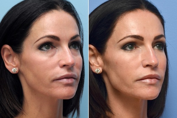 Pengisi restylane, biorevitalisasi. Ulasan. Vital, Perline, Skinbooster untuk pembesaran bibir, di bawah mata. Harga, kecekapan, gambar