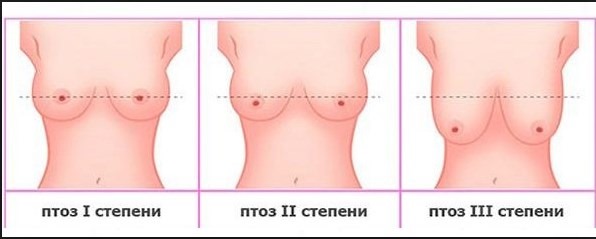 Làm nở ngực. Chi phí tại Moscow, St.Petersburg. Các loại cấy ghép, giá cả