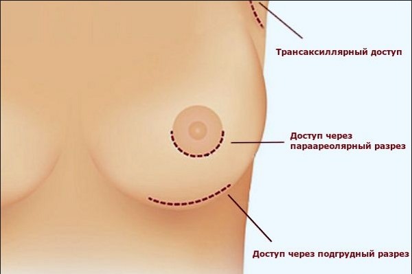 Làm nở ngực. Chi phí tại Moscow, St.Petersburg. Các loại cấy ghép, giá cả