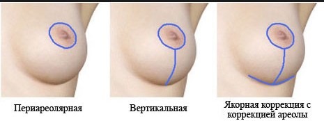 Làm nở ngực. Chi phí tại Moscow, St.Petersburg. Các loại cấy ghép, giá cả