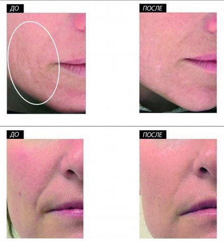 Hút chân không hydropeeling Hydra Feshl hydrafacial. Quy trình này là gì, mô tả, thiết bị, giá cả