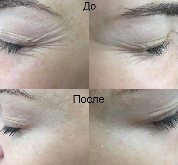 Hút chân không hydropeeling Hydra Feshl hydrafacial. Quy trình này là gì, mô tả, thiết bị, giá cả