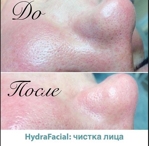 Hút chân không hydropeeling Hydra Feshl hydrafacial. Quy trình này là gì, mô tả, thiết bị, giá cả