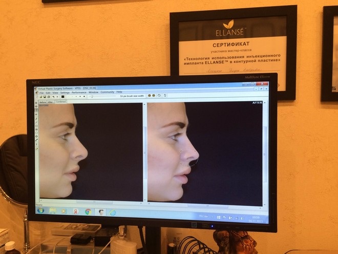 فيكتوريا رومانيتس قبل وبعد الجراحة التجميلية. الصورة ، الوزن والطول ، معلمات الشكل. ما الذي تغير بعد فقدان الوزن والعمليات