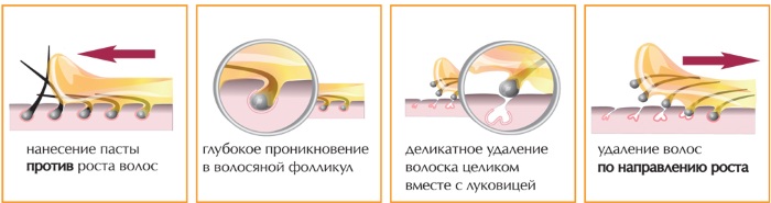 Lông mọc ngược ở chân, vùng bikini, lông mu sau khi cắt, nhổ lông. Điều trị có nghĩa là: thuốc mỡ, kem dưỡng da, kem, tẩy tế bào chết, badyaga, Bepanten, Levomekol
