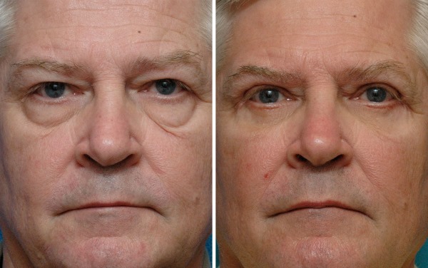 Blepharoplasty. Nhận xét về hoạt động. Ưu nhược điểm của phẫu thuật thẩm mỹ, biến chứng, phục hồi chức năng. Laser, transconjunctival, tròn, tiêm