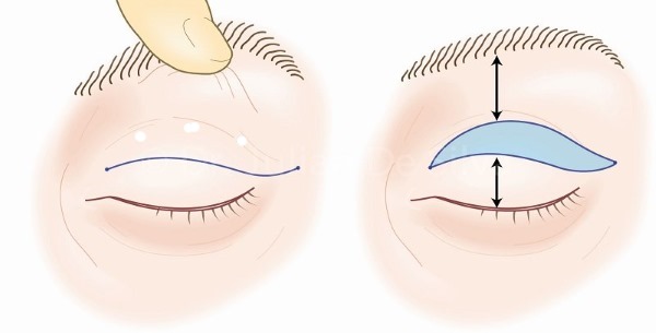 Blepharoplasty. Nhận xét về hoạt động. Ưu nhược điểm của phẫu thuật thẩm mỹ, biến chứng, phục hồi chức năng. Laser, transconjunctival, tròn, tiêm