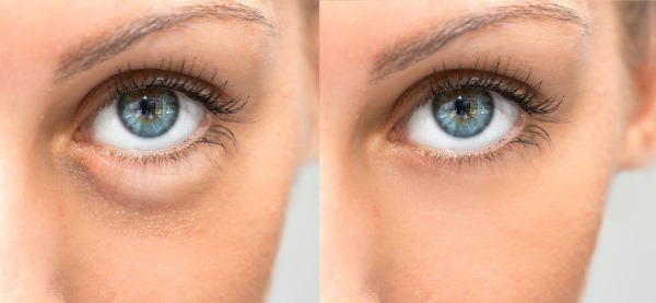Blepharoplasty. Nhận xét về hoạt động. Ưu nhược điểm của phẫu thuật thẩm mỹ, biến chứng, phục hồi chức năng. Laser, transconjunctival, tròn, tiêm