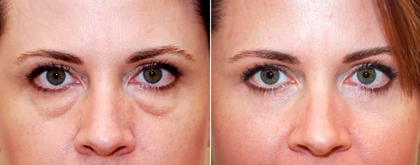 Blepharoplasty. Nhận xét về hoạt động. Ưu nhược điểm của phẫu thuật thẩm mỹ, biến chứng, phục hồi chức năng. Laser, transconjunctival, tròn, tiêm