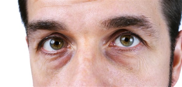 Blepharoplasty. Nhận xét về hoạt động. Ưu nhược điểm của phẫu thuật thẩm mỹ, biến chứng, phục hồi chức năng. Laser, transconjunctival, tròn, tiêm