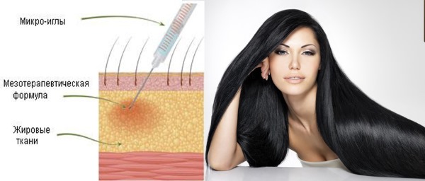 Mesotherapy vùng da đầu. Nó là gì, tác dụng, giá cả. Làm thế nào để làm điều đó tại nhà