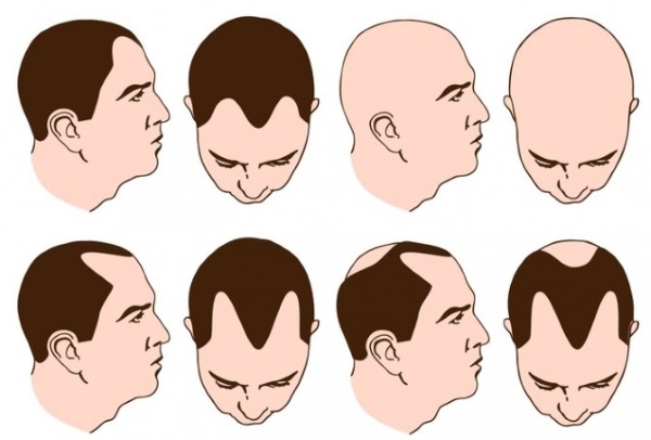 Mesotherapy vùng da đầu. Nó là gì, tác dụng, giá cả. Làm thế nào để làm điều đó tại nhà