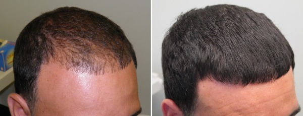 Mesotherapy vùng da đầu. Nó là gì, tác dụng, giá cả. Làm thế nào để làm điều đó tại nhà