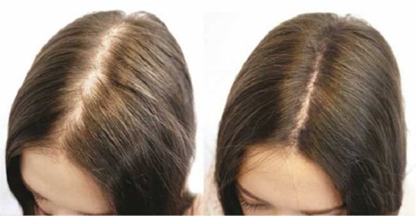 Mesotherapy vùng da đầu. Nó là gì, tác dụng, giá cả. Làm thế nào để làm điều đó tại nhà