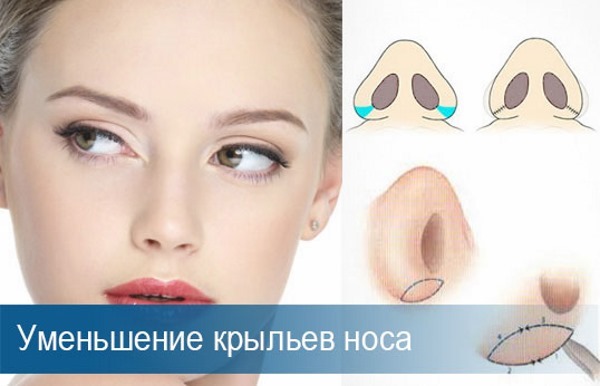 Nâng mũi ở Moscow. Giá cả và đánh giá cho các phòng khám ở thủ đô