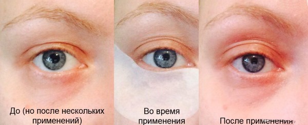 Ласерска блефаропластика. Прегледи оперисаних доњих, горњих капака, како то раде. Цене