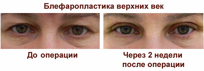 Ласерска блефаропластика. Прегледи оперисаних доњих, горњих капака, како то раде. Цене