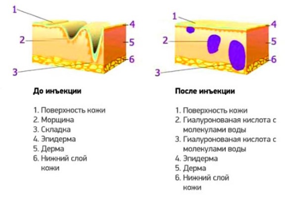 Mesotherapy vùng da đầu. Nó là gì, tác dụng, giá cả. Làm thế nào để làm điều đó tại nhà