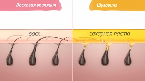 Fotoepilação ou depilação a laser, shugaring, eletrólise. Qual é melhor, prós e contras