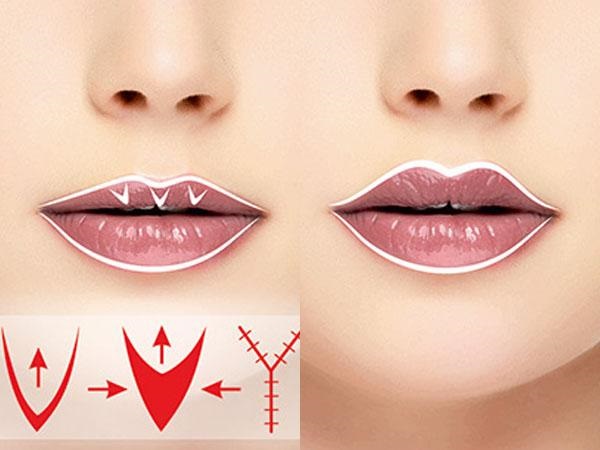 Cara membesarkan bibir dengan asid hyaluronik, botox, silikon, lipofilling, cheiloplasty. Foto, harga, ulasan