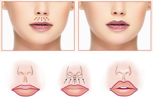 Cara membesarkan bibir dengan asid hyaluronik, botox, silikon, lipofilling, cheiloplasty. Foto, harga, ulasan