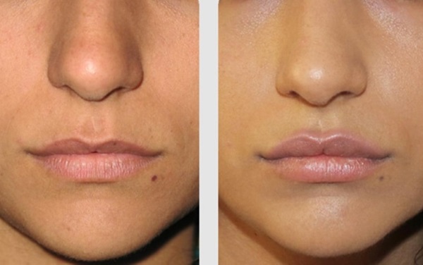 Cara membesarkan bibir dengan asid hyaluronik, botox, silikon, lipofilling, cheiloplasty. Foto, harga, ulasan