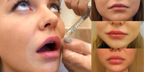 Cara membesarkan bibir dengan asid hyaluronik, botox, silikon, lipofilling, cheiloplasty. Foto, harga, ulasan