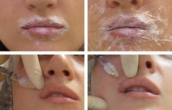 Cara membesarkan bibir dengan asid hyaluronik, botox, silikon, lipofilling, cheiloplasty. Foto, harga, ulasan