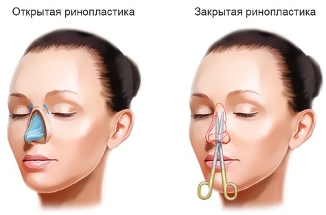 Nâng mũi ở Moscow. Giá cả và đánh giá cho các phòng khám ở thủ đô