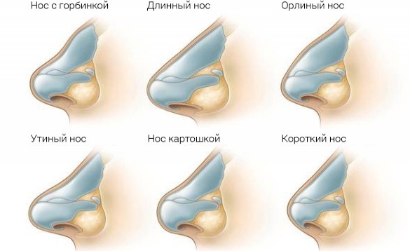 Риносептопластика. Шта је то, отворено, затворено, ласерска операција, период рехабилитације, цене