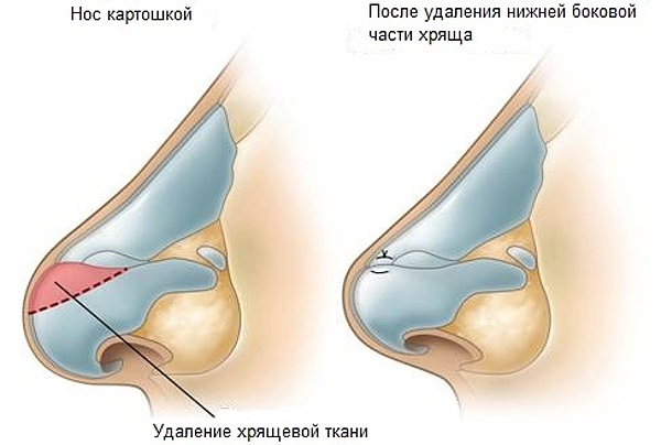 Риносептопластика. Шта је то, отворено, затворено, ласерска операција, период рехабилитације, цене
