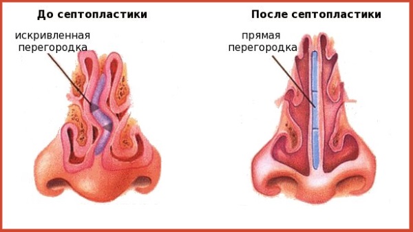 Риносептопластика.Шта је то, отворено, затворено, ласерска операција, период рехабилитације, цене