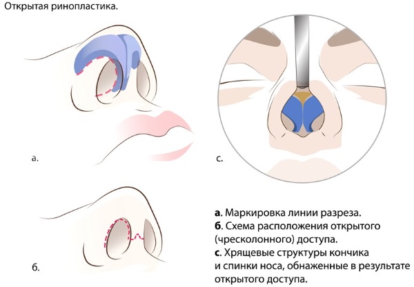 Риносептопластика. Шта је то, отворено, затворено, ласерска операција, период рехабилитације, цене