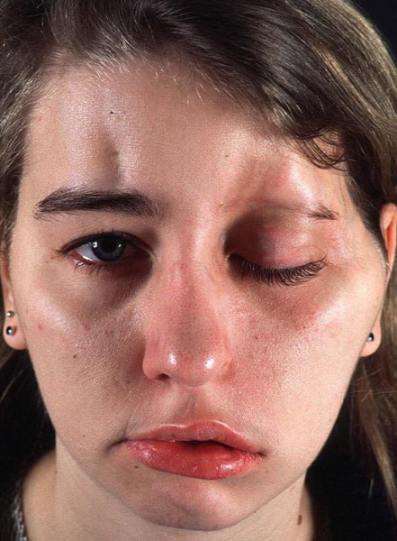 ديسبورت. ما هو هذا الإجراء في التجميل. سعر الدواء ، التعليمات ، موانع الاستعمال