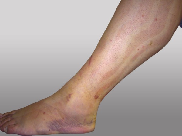 Gravação Kinesio. O que é isso em cosmetologia, medicina, esportes. Fitas, estética, drenagem linfática de rugas, dobras nasolabiais