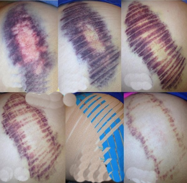 Gravação Kinesio. O que é isso em cosmetologia, medicina, esportes. Fitas, estética, drenagem linfática de rugas, dobras nasolabiais