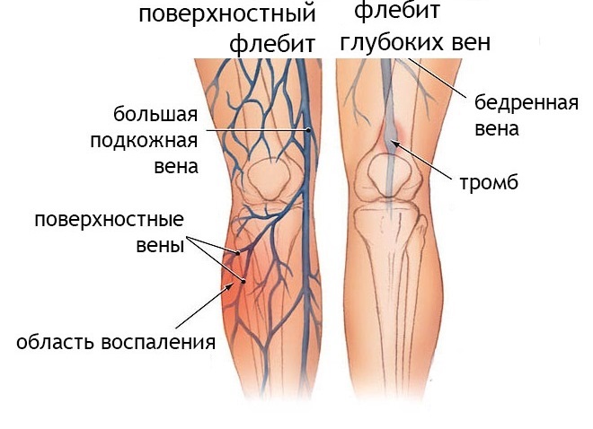 Đào tạo MPF. Nó là gì, thể dục để giảm cân, chương trình đào tạo, tập thể dục