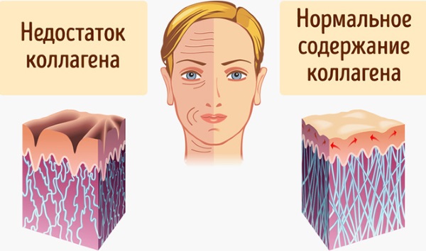 Tiêm tạo đường nét trên khuôn mặt. Nó là gì. Ảnh trước và sau, chuẩn bị, giá cả