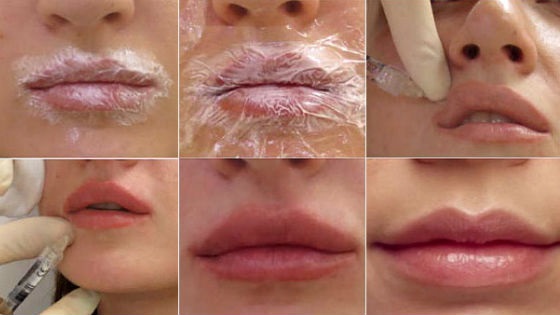 Tiêm tạo đường nét trên khuôn mặt. Nó là gì. Ảnh trước và sau, chuẩn bị, giá cả
