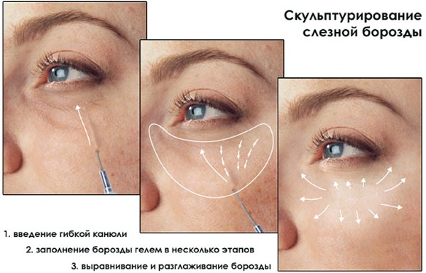 Tiêm tạo đường nét trên khuôn mặt. Nó là gì. Ảnh trước và sau, chuẩn bị, giá cả