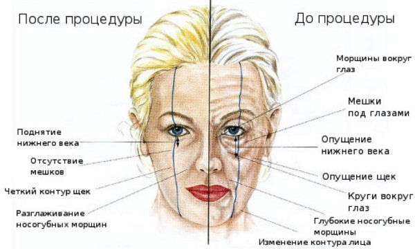 Tiêm tạo đường nét trên khuôn mặt. Nó là gì. Ảnh trước và sau, chuẩn bị, giá cả