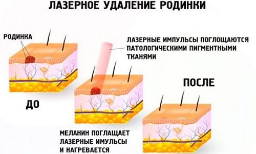 Cách tẩy nốt ruồi trên mặt bằng thẩm mỹ, phương pháp tại nhà